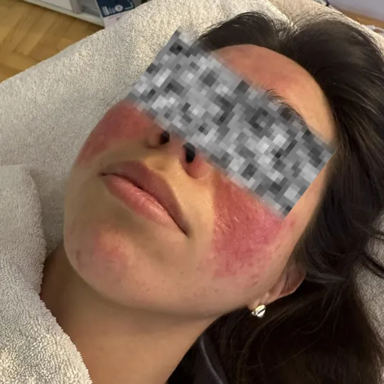 Tretirannje crvenila lica, tretman Rozacea