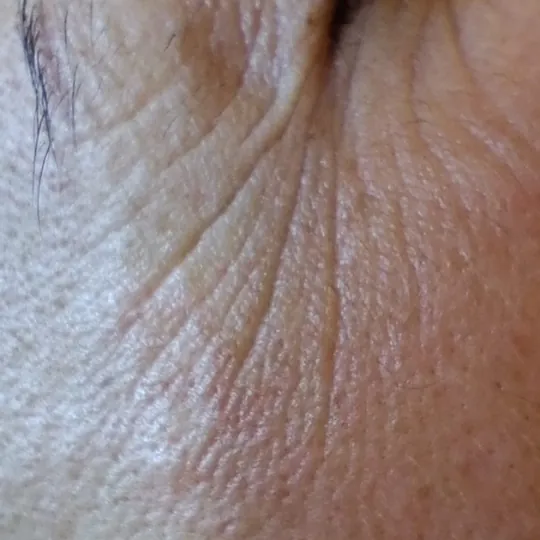 Anti Age tretman bora i foto starenja kože