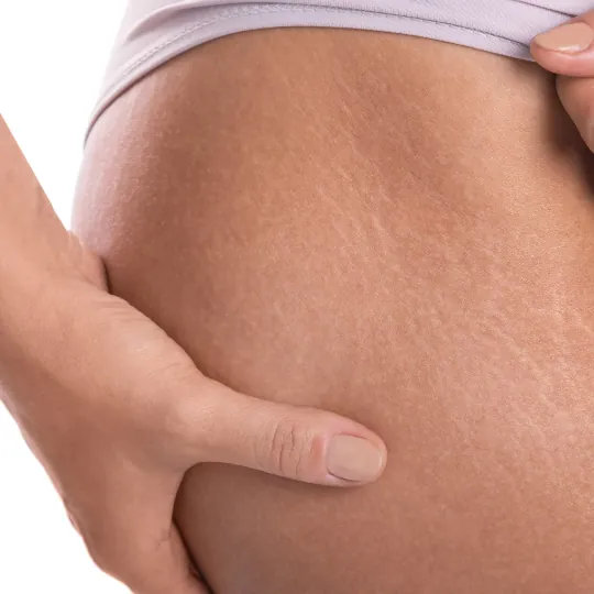 Tretman strija u studiju lilium